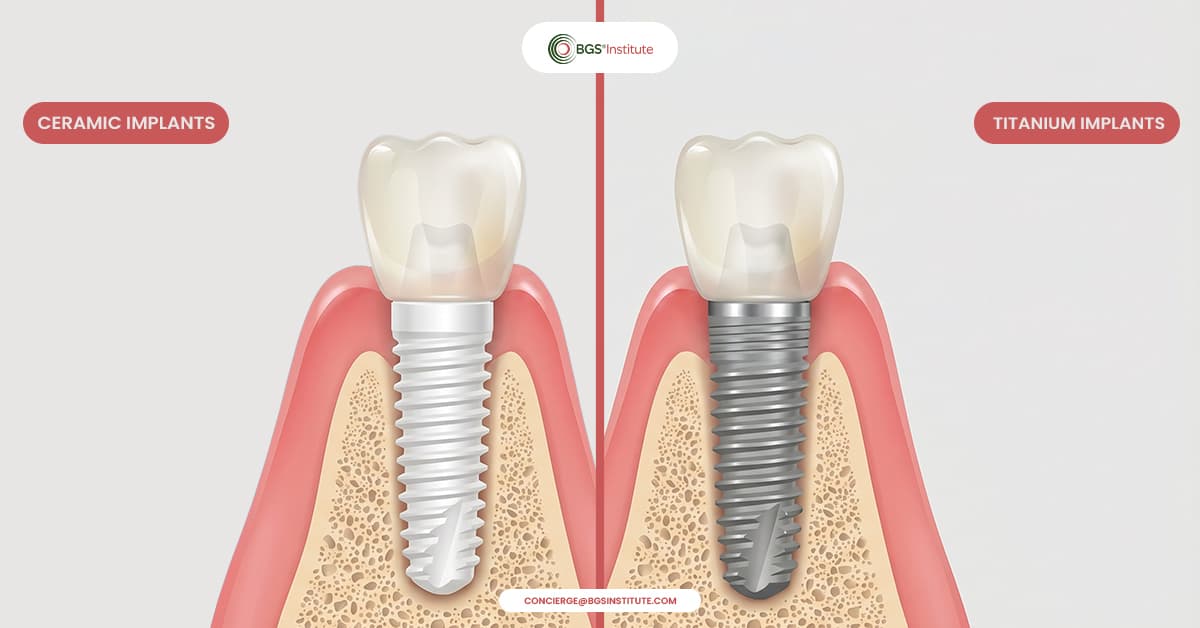 Ceramic vs titanium dental implants comparison in Biological Dentistry for safer tooth replacement